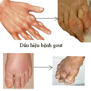 dau-hieu-benh-guout(1)